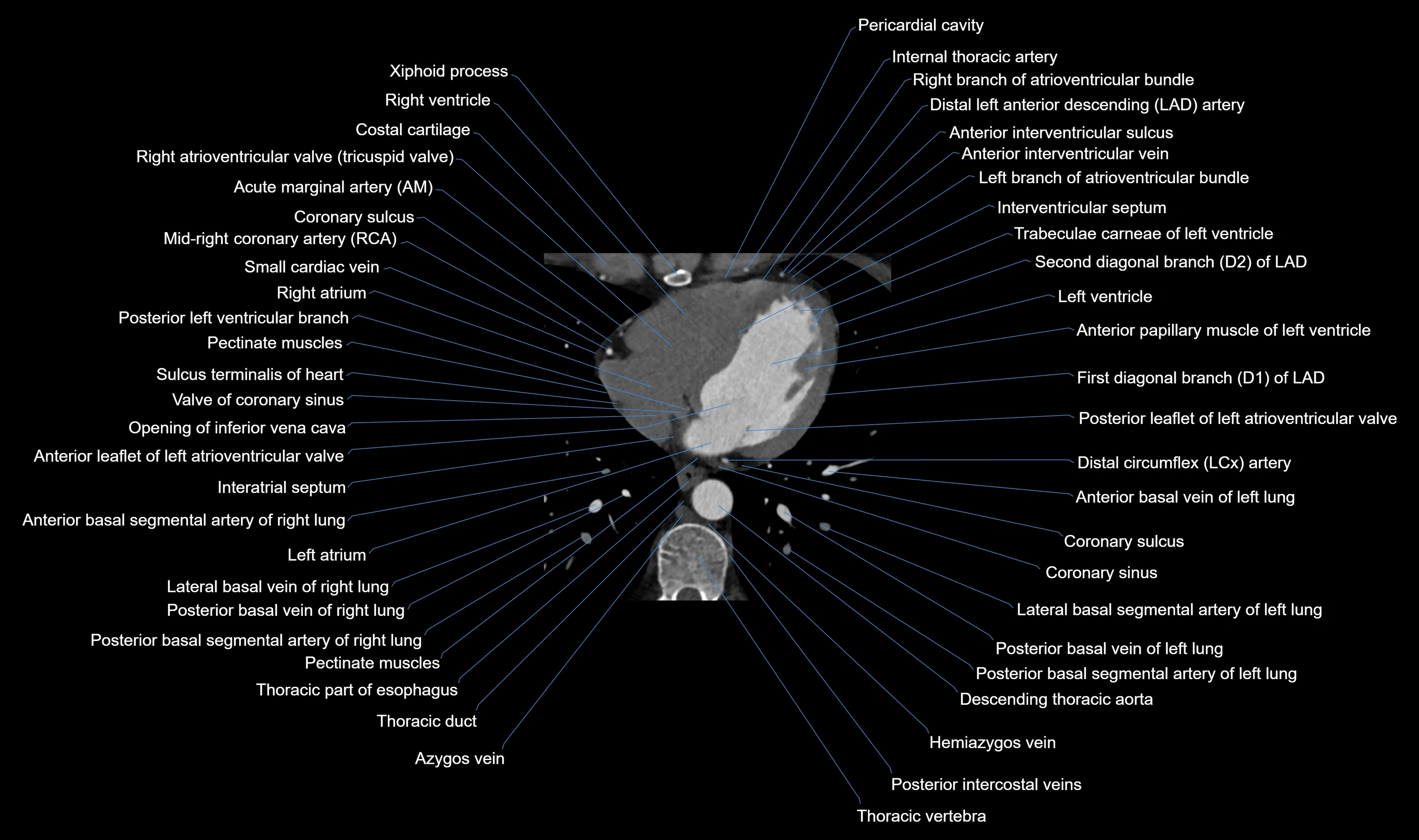 CT heart (coronary angiogram) axial view cross sectional anatomy labelled radiology image-00046.webp